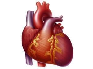 Heart with congestive heart failure showing an enlarged left ventricle.