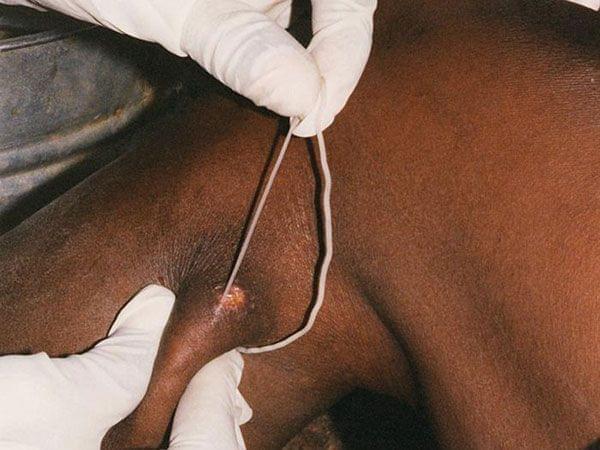 Guinea worm is removed from patient's leg.