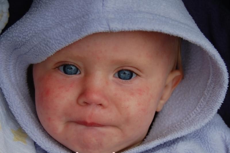 A young child with measles.