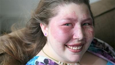 a woman with a birthmark on her face